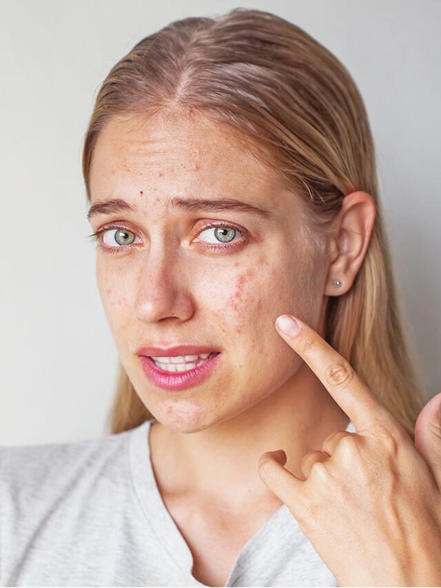 Acne-Scars--Can-You-Get-Rid-Of-Them-Using-Home-Remedies