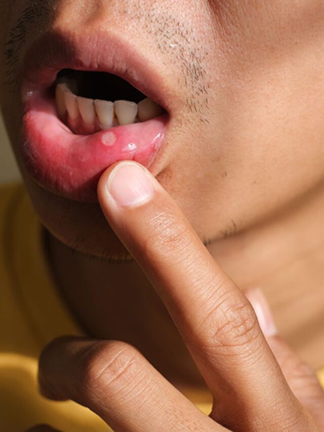 Effective natural remedies for mouth ulcers